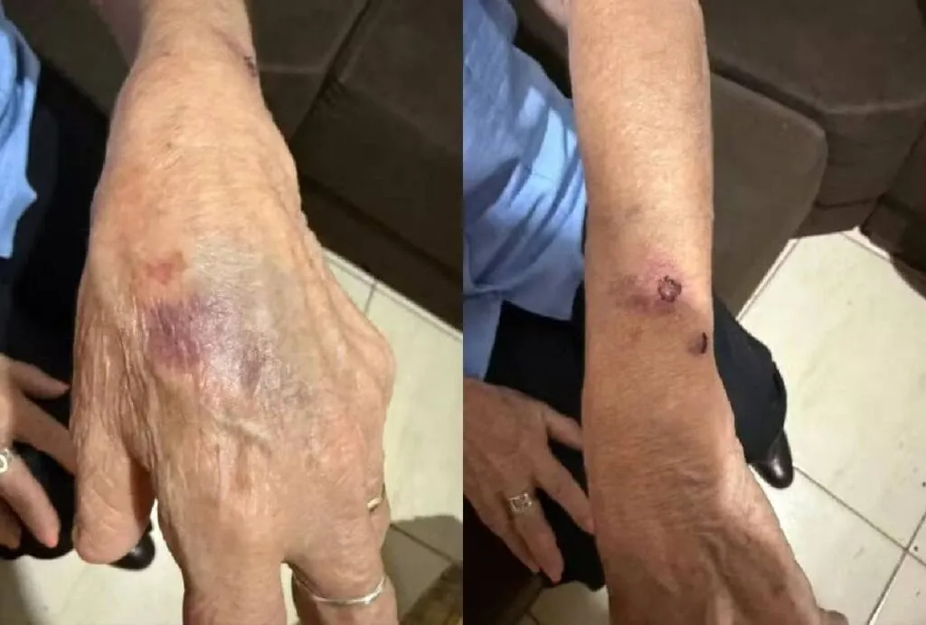 Ela teve hematomas nos braços e mãos, um dente quebrado e dores na coluna