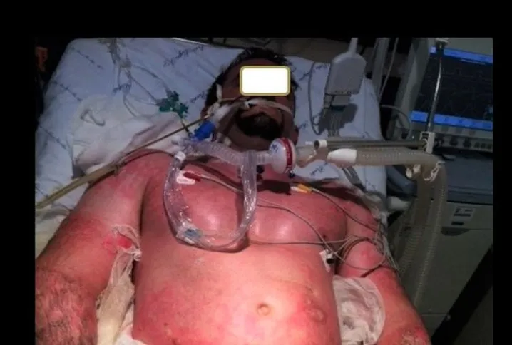 Imagem ilustrativa da imagem Boate Kiss: trauma psicológico persiste entre sobreviventes